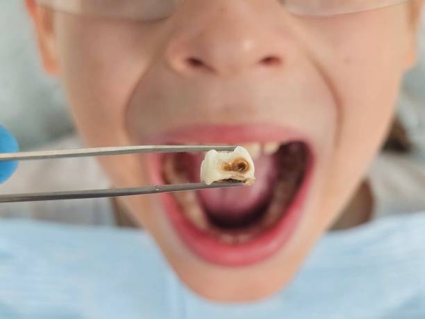 Best Emergency Care for Gum Disease in Ville Ptte, LA